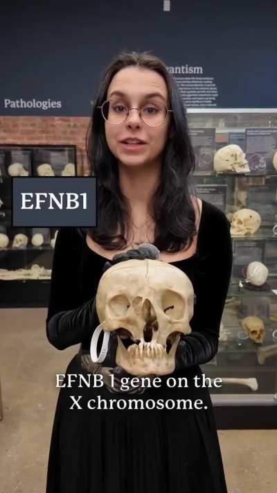 Craniofrontonasal Syndrome on a REAL Skull