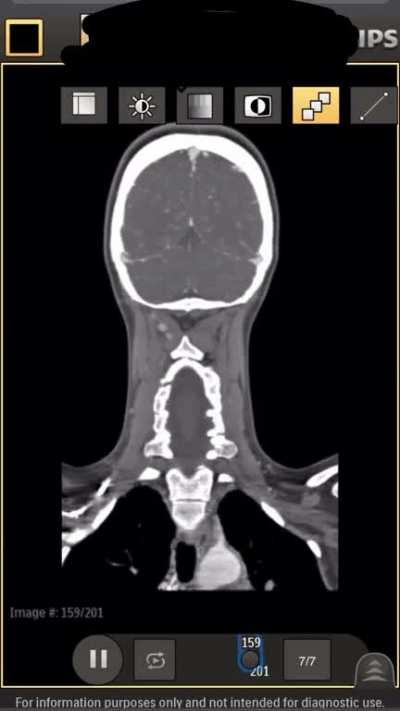 Had bilateral carotid bypass surgery in 2018, body has recently decided to ignore the right graft and use the partially occluded artery instead