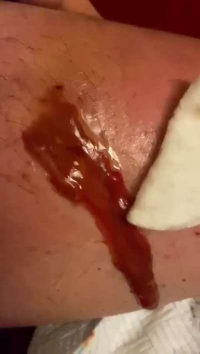 During lock down, I was bitten by a False Widow Spider on my  Calf, it got a secondary infection that needed draining and a 2 months of Antibiotics to rid the infection fully. It has left me with a 2” circular dent in my muscle, that even now sinks down a