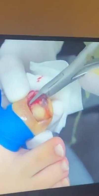 “He’s cutting her whole nail out”