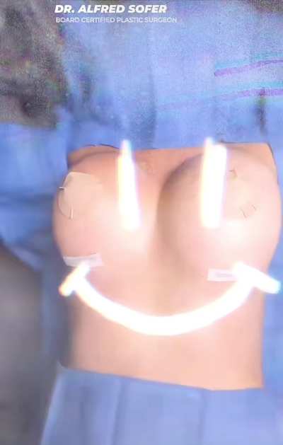 Breast implants before and after