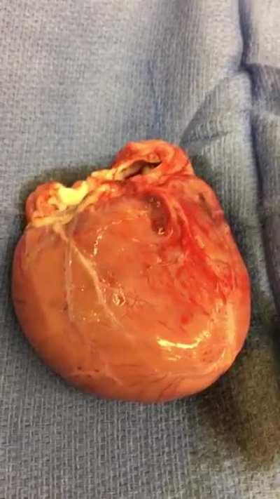 Someone posted a heart awaiting implant so here’s one that had just been explanted
