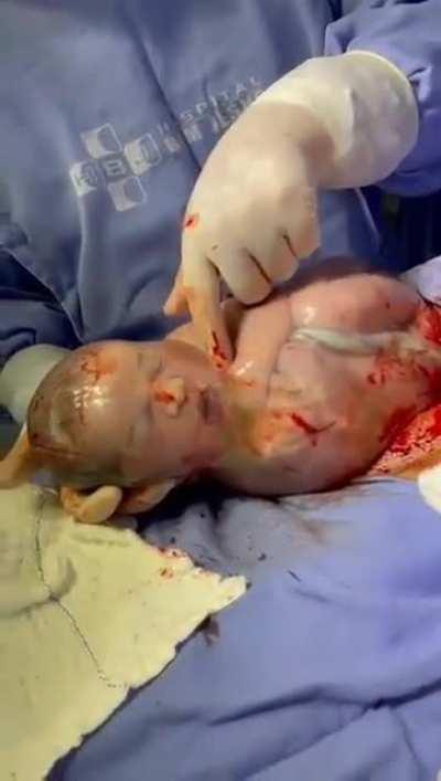 Baby born in amniotic sac