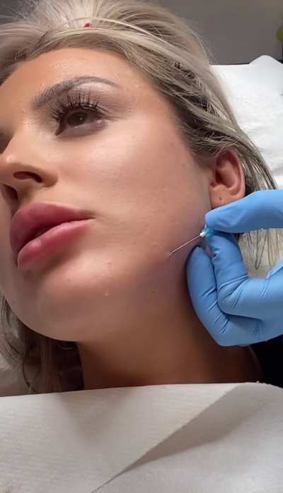 Come get a 10ml full face filler package (jaw, cheeks, chin, nose, Russian lips)