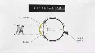 Vision System And Refractive Errors That Impair The System