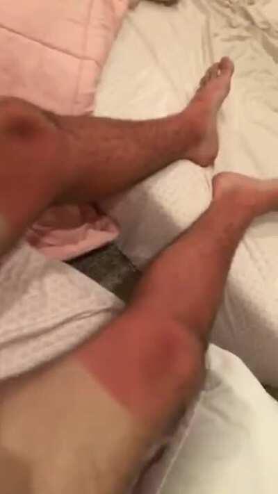 Result of kayaking without sunscreen