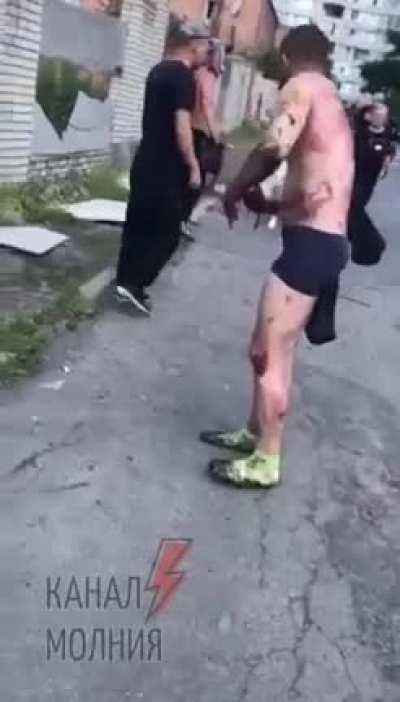 Vinnitsia. Shredded fingers.