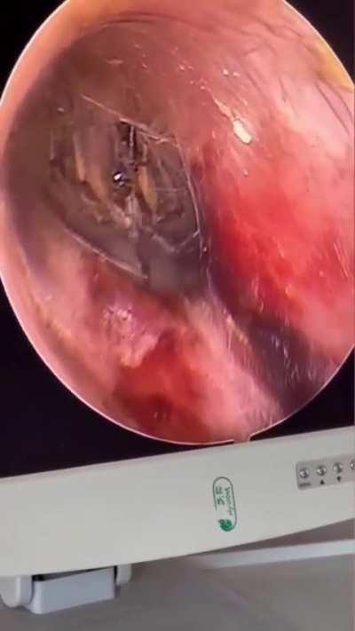 Spider crawls in a guy’s ear while he slept