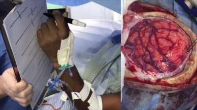 While operating near sensorimotor areas of the brain