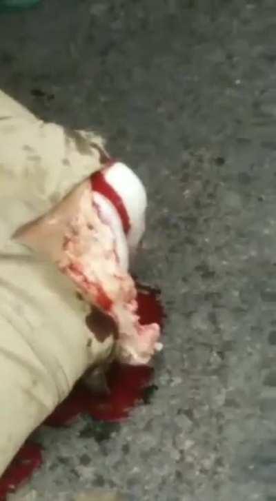 Otra perspectiva de la rodilla