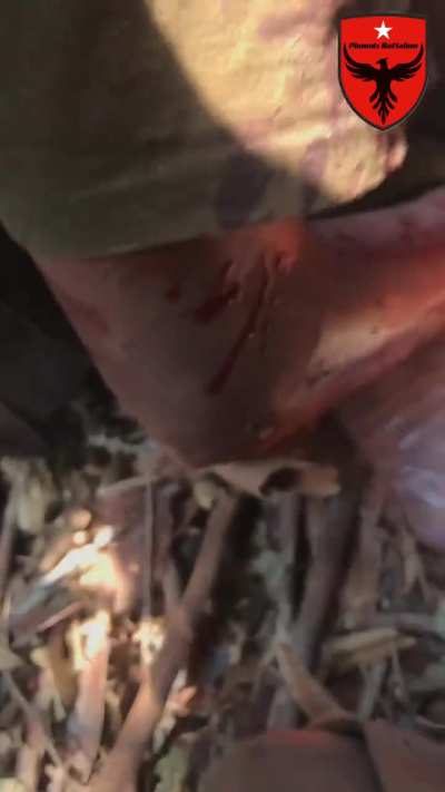 [Myanmar/Burma] During the Battle of Mobye, two Phoenix Battalion rebels were injured by artillery. One is currently receiving treatment (March 14)