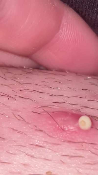 Probably ingrown hair