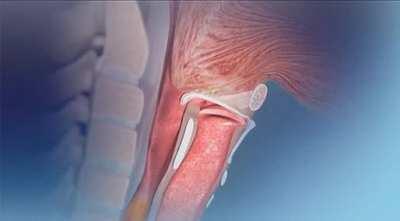 How the epiglottis works while swallowing, preventing food and drink from going to lungs
