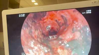 This is what inhalation injury looks like when we bronch patients.