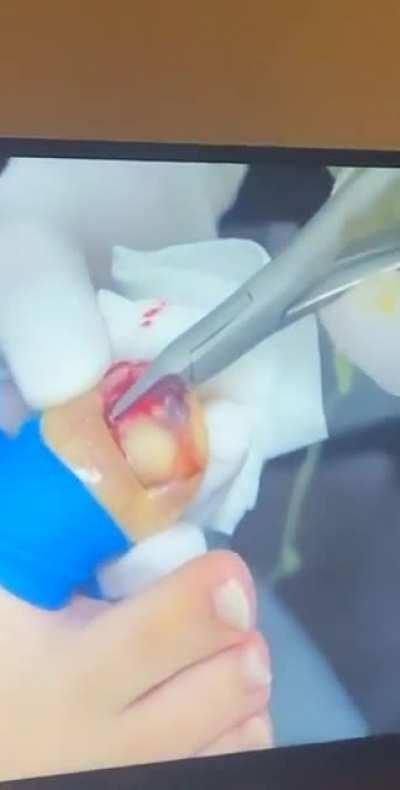 “He’s pulling her whole nail out!!”