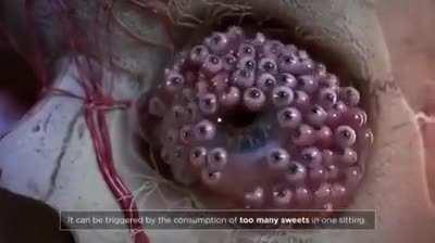 Thanks, I hate acute multiocular orbital hyperproliferation