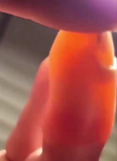 This video shows a distal phalanx of the finger that is no longer attached to the overlying tissue and moves freely in the fluid filled fingertip! The assumption is that the mechanism of this injury was inflating his finger with compressed butane or propa