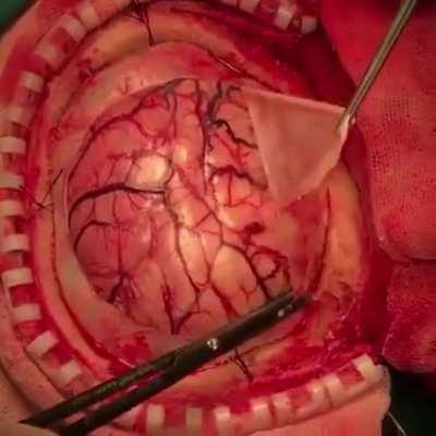 Clip of a neurosurgery showing one of the methods of how the dura is cut