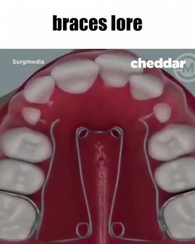 Braces Lore