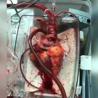 Human heart waiting for transplantation