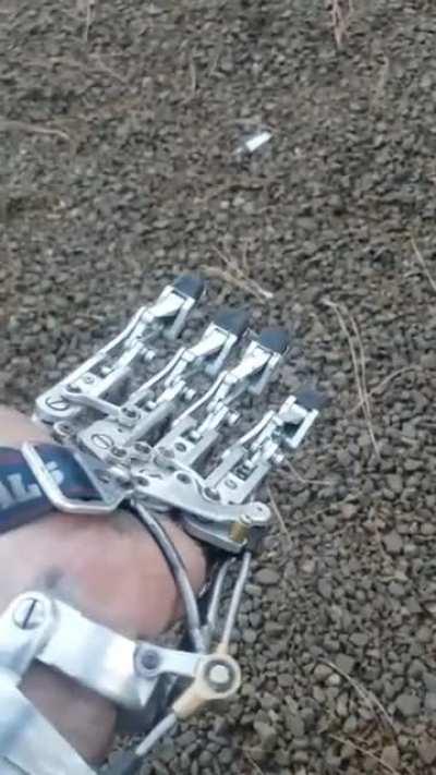 While fighting against Multiple Myeloma, Ian Davis makes his own Prosthetic Hand