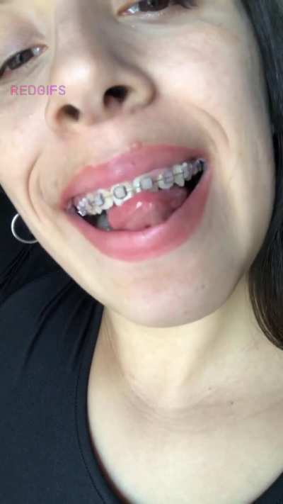 Sometimes I get bored and I like to play with my braces, am I weird?