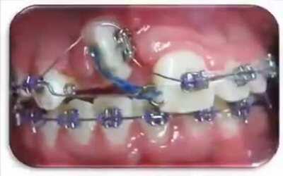 A time-lapse of bracers doing their best job