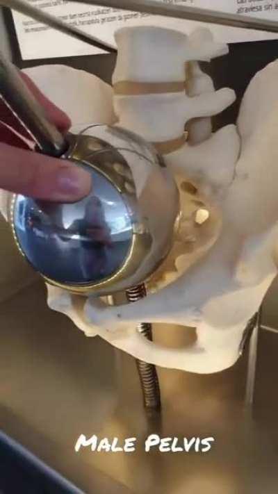 Sexual dimorphism of the human pelvis illustrated. The balls represent the size of a newborn baby's head, which will pass through the female pelvis fairly easily, but will get stuck in the male pelvis.