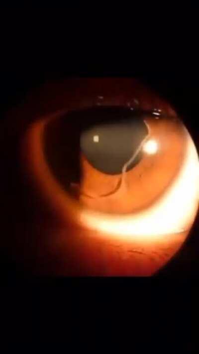 A parasitic worm swimming inside human eye