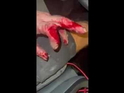 Stone cutter blade exploded. Felt it shaking, but only had 1/4 inch more to cut. Both finger miraculously repaired!