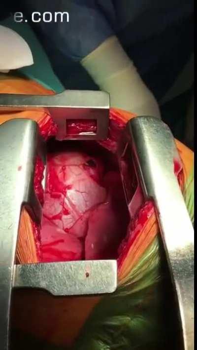 Surgeon carefully pulls out a knife that barely missed the heart