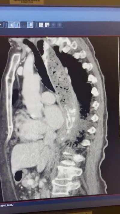 I feel like something is stuck in my throat.