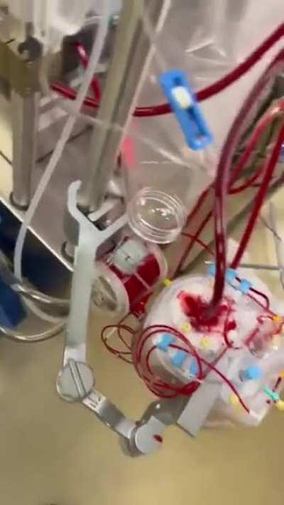 A heart which is gonna get transplanted