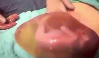 Premature baby born inside amniotic sac, kicking and rolling.