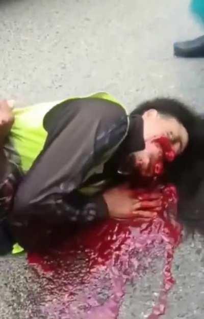 Man victim of traffic accident has his face completely disfigured.