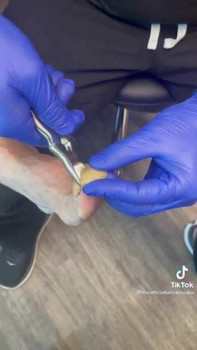 Painfully long toe nails