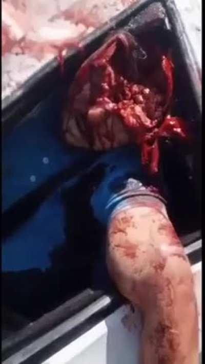 Horrible Car Accident (Brain Exposed)