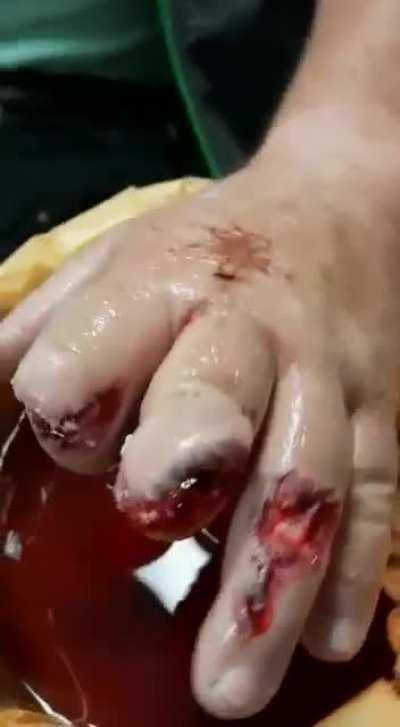 My Uncle a joiner by trade, was at work today when his circular saw jumped back an did a number on his fingers! (OC and NSFW/NSFL)
