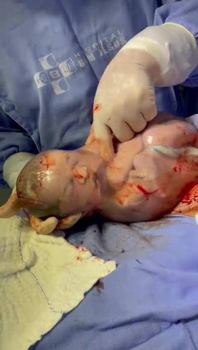 The opening of the eyes to life of this baby born inside an amniotic sac