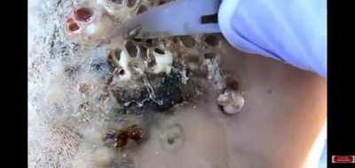 Jigger removal, a type of parasite buries it's larvas under your skin. Fun!