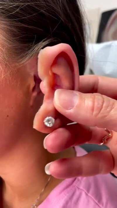 Detachable ear