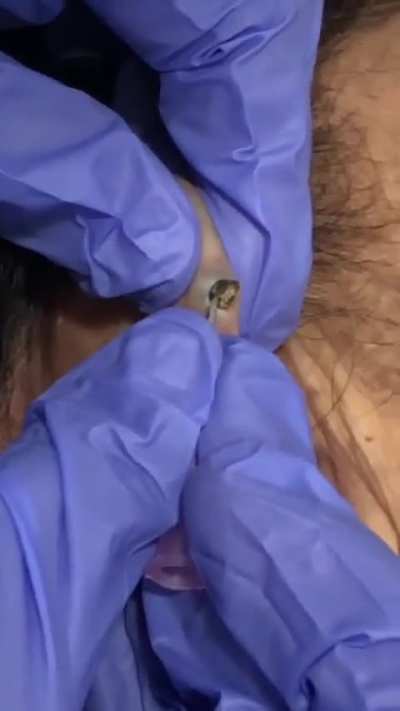 Big blackhead on the ear