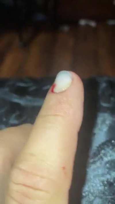 Tried to break up a fight between two Yorkies.. got bit all the way through my nail.
