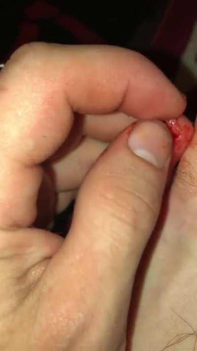 Broken toe nail
