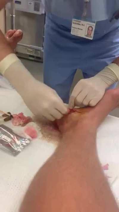 SOUND ON. Friends surfing accident. The sound is intoxicating