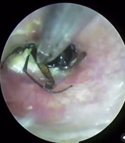 Wasp pulled out of man’s ear