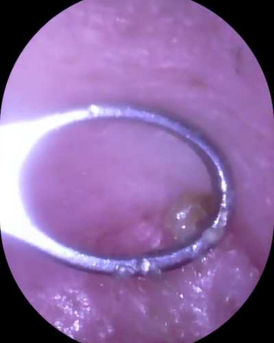 Ear blackhead removal
