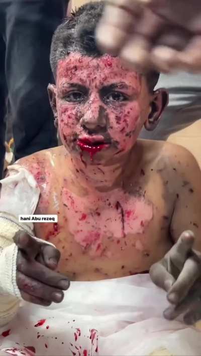 ⚠️‼️ WARNING GRAPHIC CONTENT A Palestinian child suffers from serious burns after the bombing of his home in the Nsairat refugee camp, central Gaza. 12.12.23