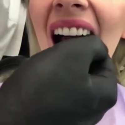 This woman having her veneer teeth installed.