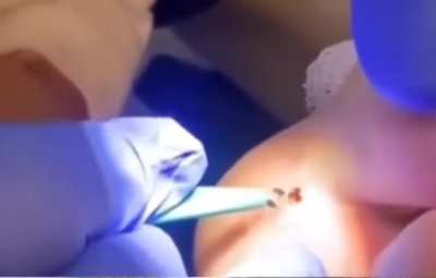 foot splinter removal